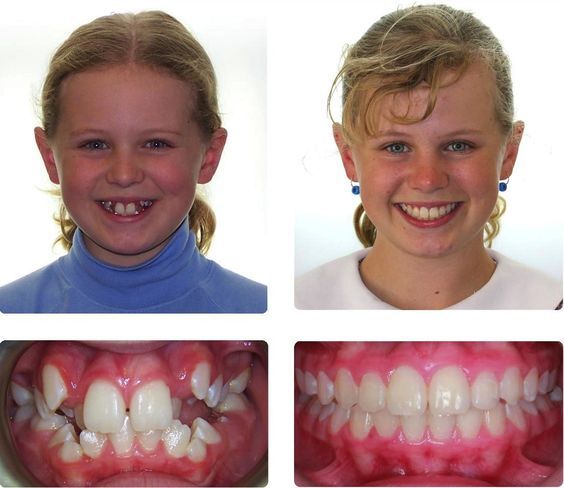 Children's Dentistry at EverSmile